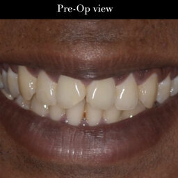 Class 4 Build-up in Adjacent Teeth Using Modified Putty Technique: Dr Varsha Rao