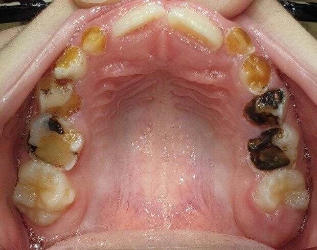 Afbeelding 5a: Kleurfoto’s op de leeftijd van 7 jaar, juli 2019. Alle cariëslaesies in de bovenkaak zijn arrested, hard en glanzend, goed bereikbaar voor het poetsen. De mondhygiëne is goed. De eerste blijvende molaren breken door.