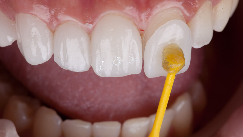 Researchers suggest their 3D-printed veneers are the future