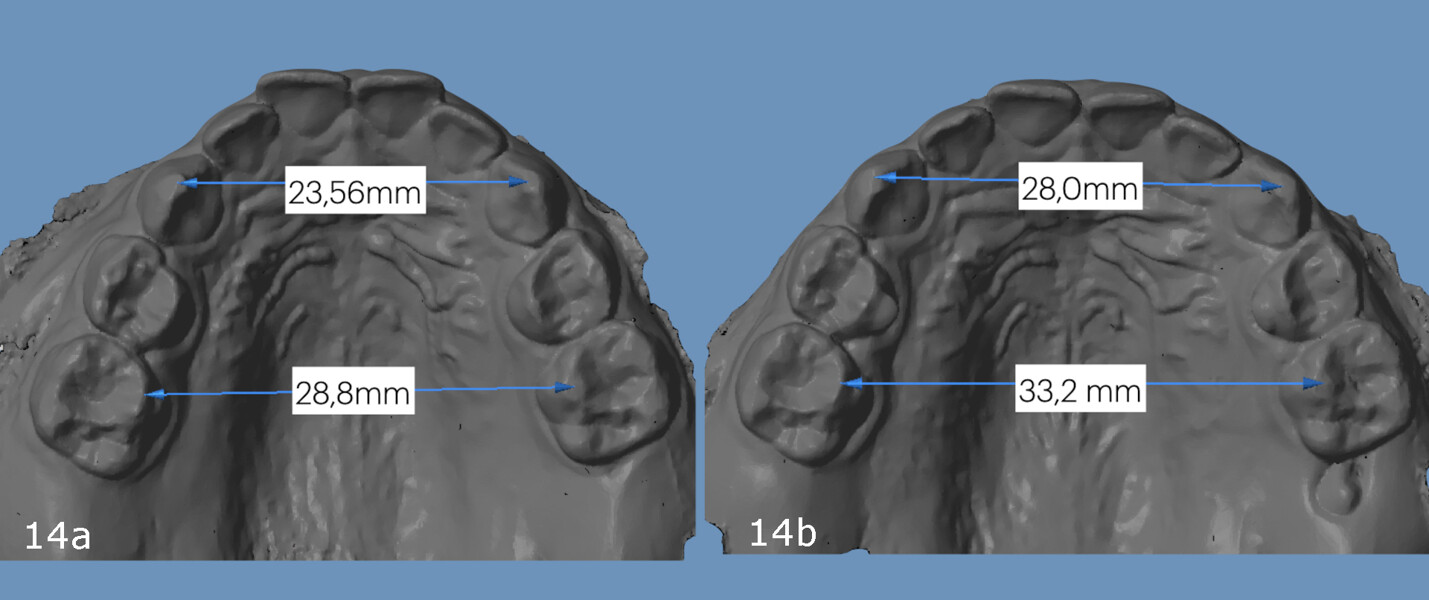 Figs. 14a & b: Palatal models before (a) and after the therapy (b) with width measurements: from 23.56 mm to 28.00 mm in inter-canine width and from 28.80 mm to 33.20 mm in inter-molar width.