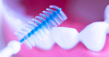 Study finds interdental brushes and rubber picks most effective devices