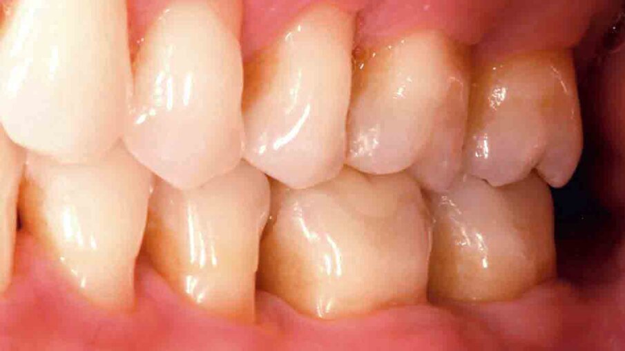 Fig. 1: Initial situation. The failed composite restoration covering a large part of the left mandibular first molar’s occlusal surface needs to be replaced.