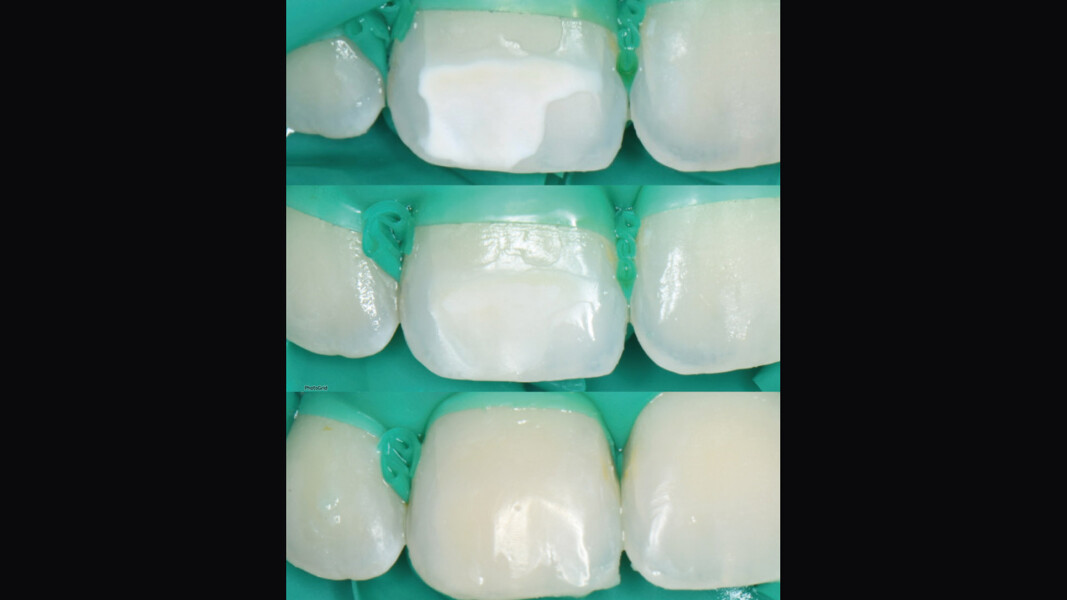 Fig. 6 - Lesione dopo sbiancamento, infiltrazione e stratificazione del composito per correggere lieve avvallamento.