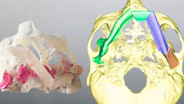 Chirurgia orale e maxillo-facciale: Rivoluzionata dai modelli 3D stampati