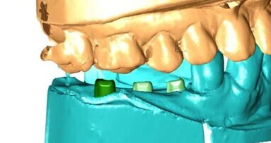 Analiza odbudowy protetycznej na implantach BellaTek Encode i Atlantis