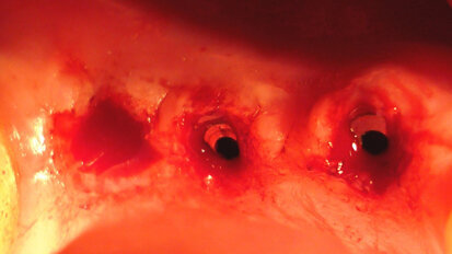 Aspetti clinici ed ergonomici dell’utilizzo del laser a diodi nella fase di scopertura implantare della tecnica “two stages”