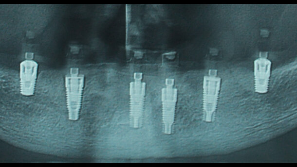 Grave atrofia mandibolare riabilitata con impianti corti a carico immediato
