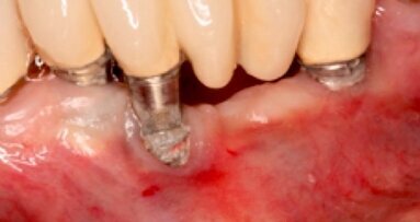 El láser en el tratamiento de la periimplantitis