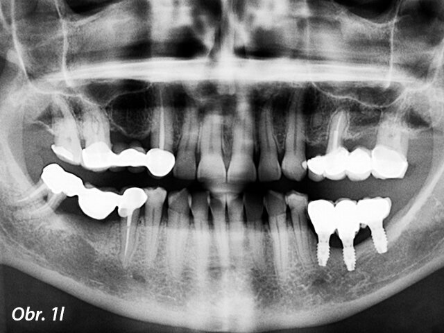 Panoramatický rentgenový snímek tři roky po zatížení