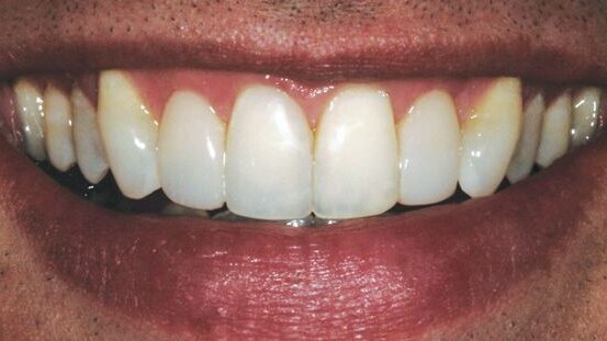 Le collage du banquier : lorsque le moins est un plus