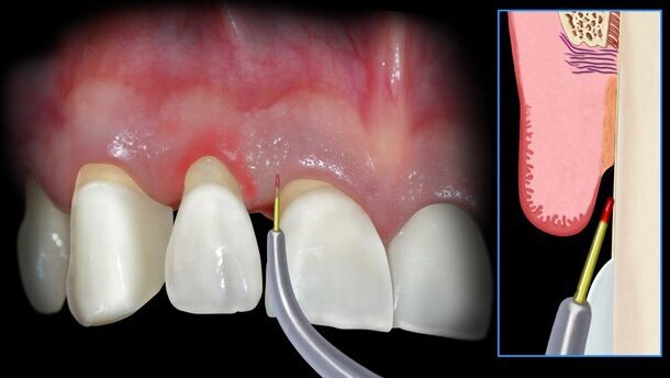 Il laser a Diodo: tecniche operative step by step, applicazioni, protocolli e casi clinici con follow-up
