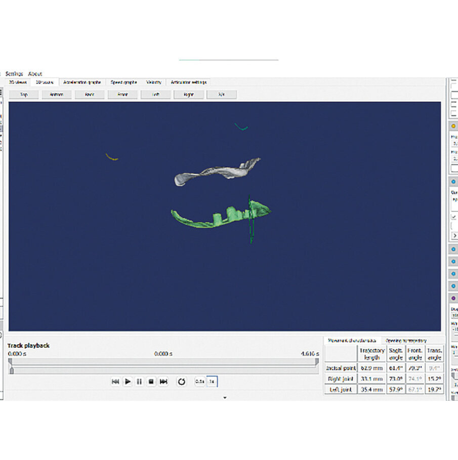 Fig. 6: Visualisation of digital maxillomandibular relationship registration.