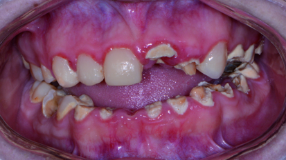 Replacing a failing dentition with new technology