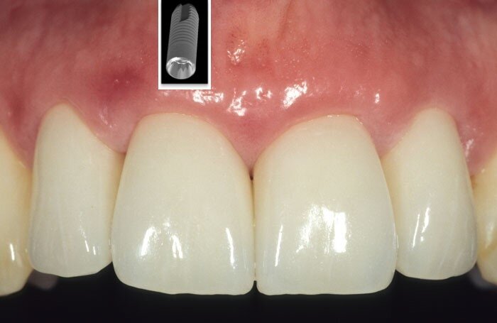 Fig. 4: Good soft tissue maintenance around implants can be often obtained by soft tissue augmentation, thus improving tissue biotype and keratinization.  
