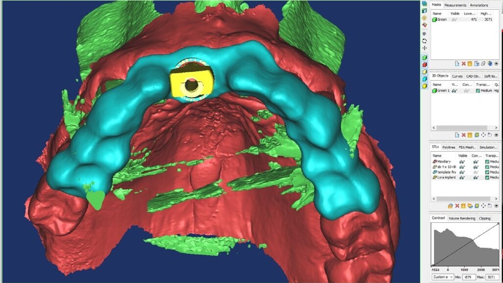 L’Intelligenza Artificiale e la Realtà Aumentata nella moderna pianificazione implantare: case report