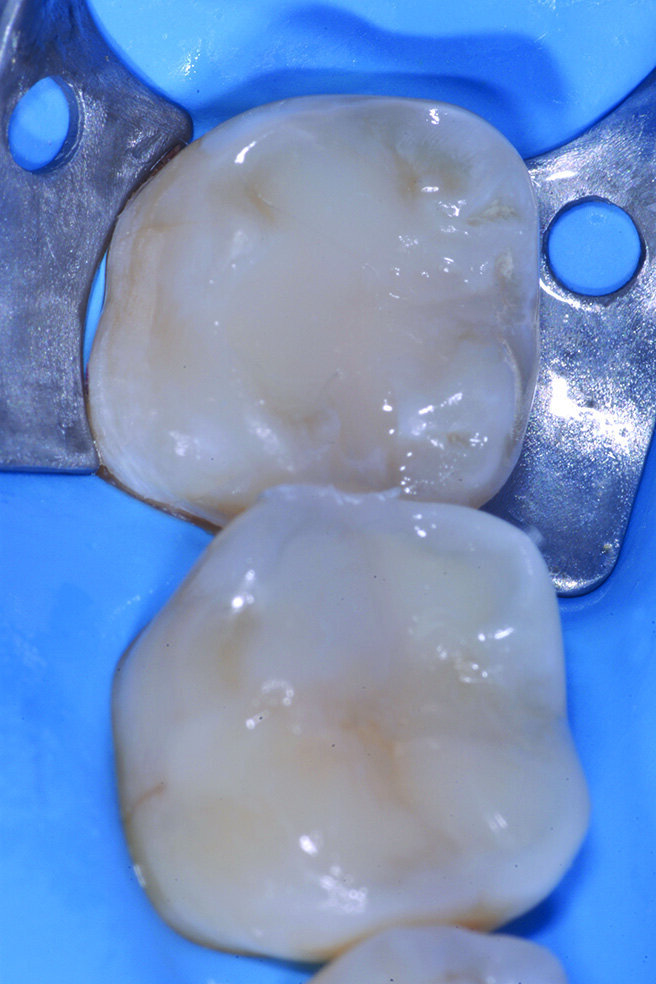 Figg. 2-5_Rimozione dei vecchi restauri presenti su 4.6 e 4.7: gli elementi vengono restaurati con tecnica diretta utilizzando dentina e smalto Enamel Plus HRI Bio Function. 