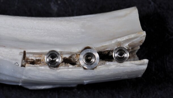 Intérêt de l’implant Fratex en présence de crêtes fines