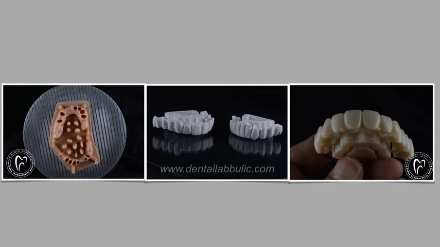 Slika 5 izgled ne sinterovane i sinterovane cirkonije, kao i printani  modela sa pokretnim radnim patrljcima (Zubna laboratorija Bulić)