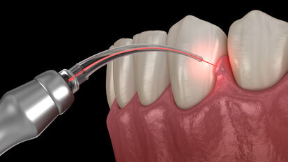 BIOLASE Academy brings dental laser education online