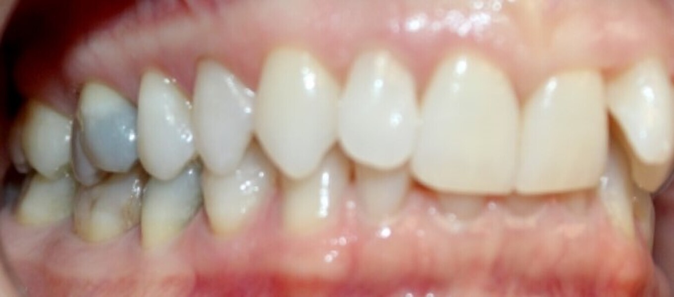 Fig. 18a: Class II malocclusion requiring fixed appliance treatment. (a) Lateral view. (b) Occlusal view.