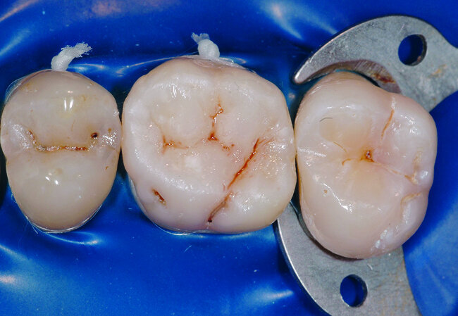 Fig. 29: Vue occlusale après caractérisation des sillons dentaires. 