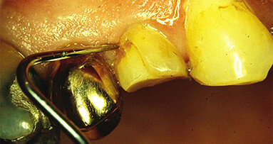Get back to control – How to deal with bleeding gingiva during restorative procedures