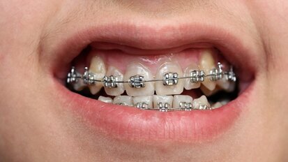 Tandartstarieven in 2013 omlaag