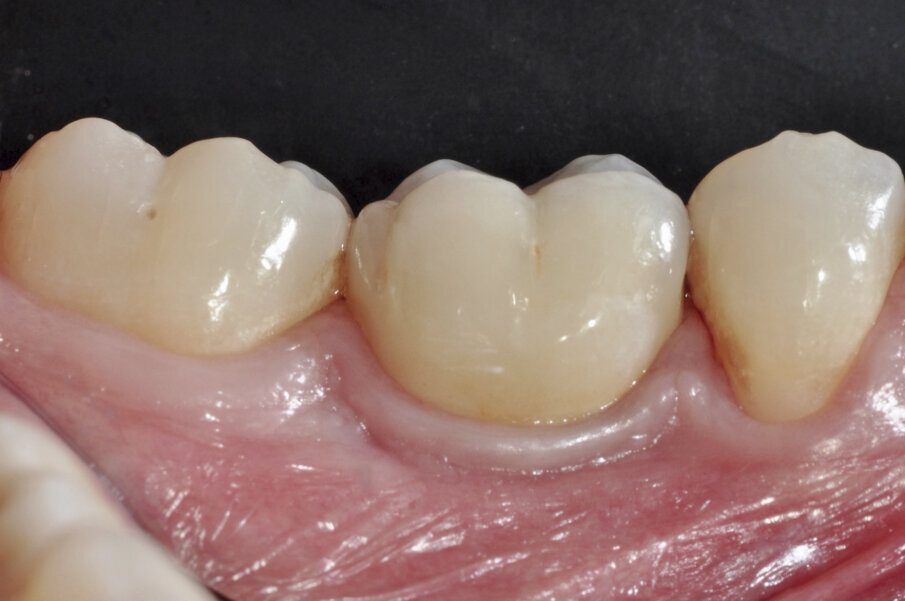 Fig. 18: After ten years, a perfect adjustment of soft tissue around
the restoration (buccal view) was observed, filling the space for the interproximal papillae and yielding a natural looking soft-tissue contour.