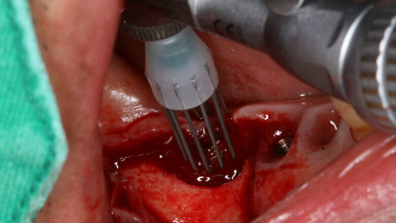 Novel surgical procedure may help combat peri-implantitis