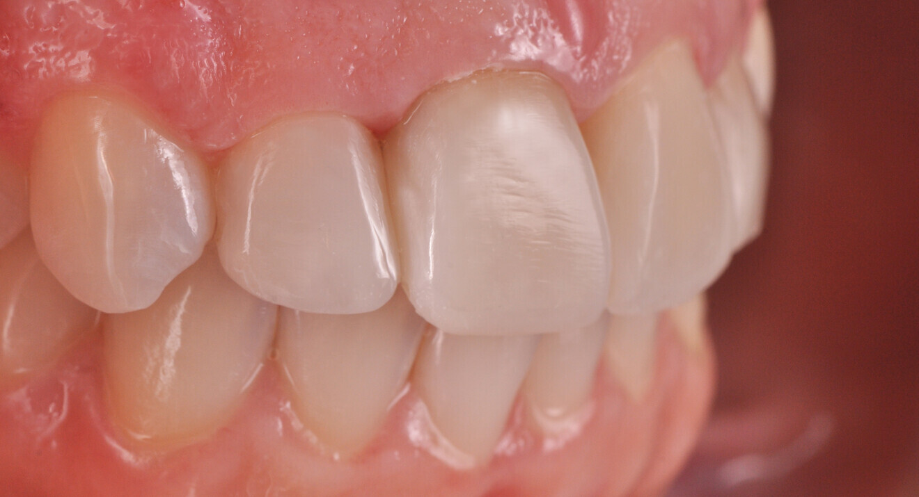 Fig. 22a: Final restoration with lifelike anatomical shape. Lateral view from the right.