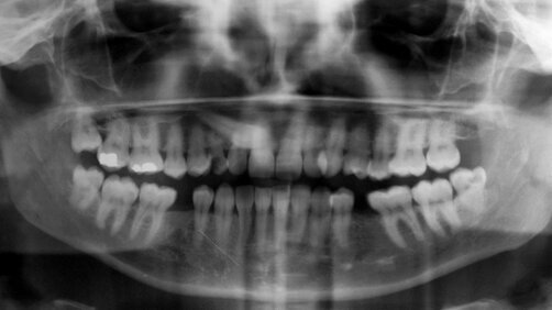 Immediate implant placement and immediate loading after a complicated tooth extraction