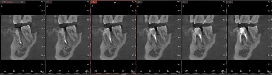 Fig. 6a: Post-op CBCT images of tooth #46 showing adequately obturated canals at all levels to the working length and sealing of the furcation defect.