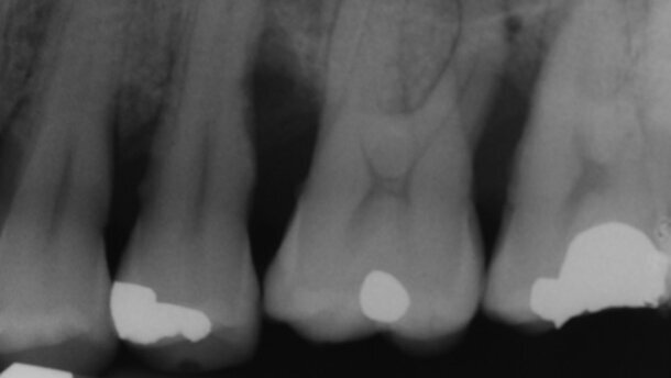 Utilizzo del laser a diodo associato  alla strumentazione parodontale non chirurgica come trattamento alternativo e nella gestione di infiammazioni recidive