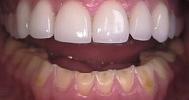 Eetstoornissen veroorzaken ernstige tanderosie