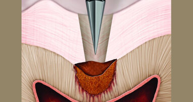 La preparación cómoda de cavidades es la clave del éxito