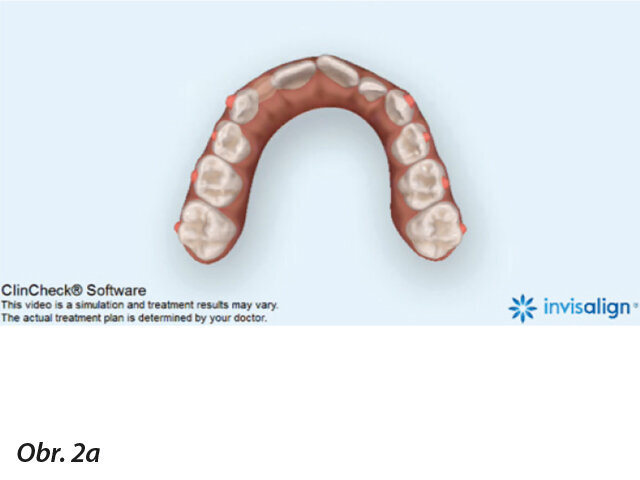 Vizualizace simultánního stagingového vzorce: Expanze oblouku je naplánována jako simultánní pohyb špičáků současně se všemi laterálními zuby. K vyrovnávání řezáků dochází už od začátku léčby (a)