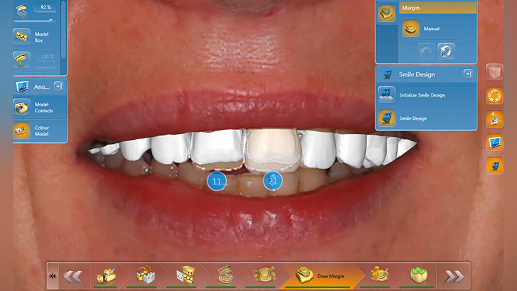 Fig. 8. La aplicación CEREC-Smile Design permite evaluar las restauraciones junto con los labios.