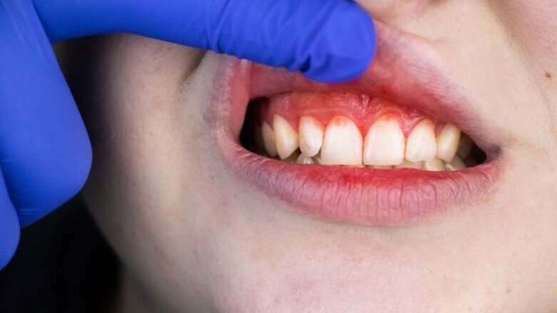 Kinderen met immuundeficiënties hebben meer kans op het ontwikkelen van parodontitis