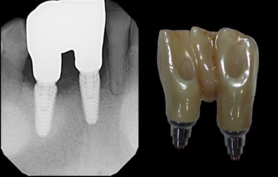 Figs. 15a & b: Radiograph of the denitive restoration (a) and the denitive restoration displaying the lingual access openings (b).