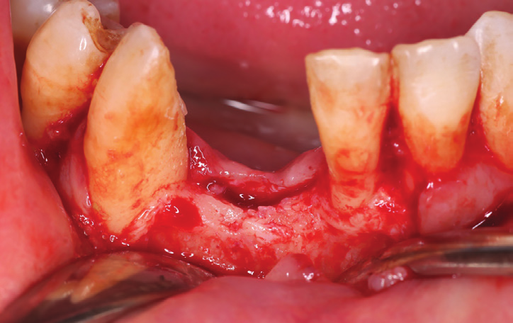 Figure 4: Preoperative view showing vertical and horizontal bone loss.