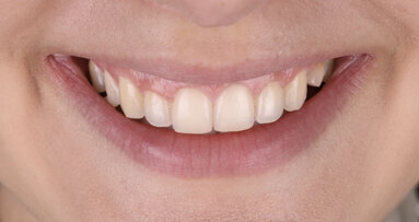 3D-printing inlays, onlays and overlays with SprintRay: A revolutionary approach to dental restorations