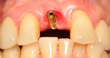 Impianti e monconi di piccolo diametro per la sostituzione di elementi in zona estetica