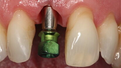 Placement of dental implants results in minimal bone loss, study shows