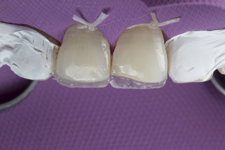 Fig. 8: Palatal shell made using Shofu Injectable INC enamel shade