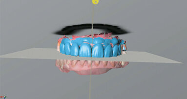 Nový úsměv za jeden den