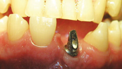 10 rules of order in implantology
