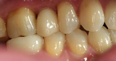 Implants en zircone : remplacement entièrement sans métal d’une deuxième prémolaire maxillaire