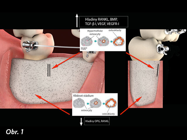 Alveolární kortikotomie
