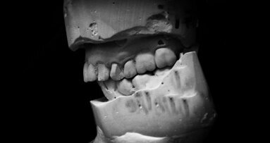 Cast mounting using MaxAlign: The clinical component