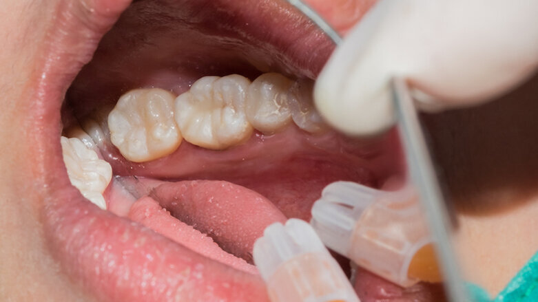 Von der Matrize bis zur Füllung: So gelingt die Seitenzahnrestauration